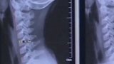 28岁女孩常年伏案工作 颈椎退化严重险瘫痪