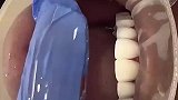 原来牙齿也可以贴膜