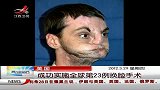 晨光新视界-20120329-成功实施全球第23例换脸手术