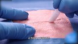 最牛黑科技“医用胶水” 60秒愈合伤口不留疤 专家：疤痕克星