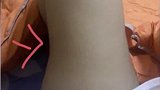 湖南长沙：借2万整形贷，抽脂后两腿不对称了？！女子傻眼