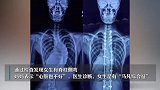 13岁女生长到1米8，检查后医生不淡定了：赶紧手术！