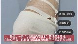 “小腿肌肉阻断术”冲上热搜，自残式变美一点也不美