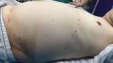 男子腹中40斤肿瘤随时破裂 医生鏖战八小时手术过程宛如“拆弹