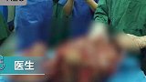 西安21岁女孩腹中切除25斤肿瘤，就医前腹部隆起如足月孕妇肿瘤