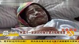 阿富汗一家因拒嫁女 全家被泼硫酸报复