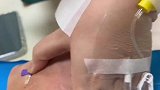 护士比我病重，扎着针来给我扎针