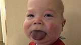 男婴天生巨舌症收不回嘴里 孕期B超吐舌头妈妈还觉得好可爱