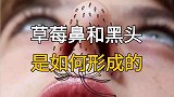 草莓鼻和黑头是如何形成的？