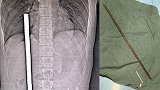 揪心！1米多长钢筋从22岁小伙下体穿入 距心脏仅3厘米