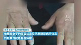 女子饭店吃饭被外科医生提醒患肿瘤，确诊后经治疗情况已好转