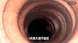 姐姐刚患癌去世，弟弟一查肠癌晚期“我母亲也患有”，医生：遗传率为50%