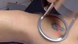 洗纹身就是用激光把皮肤烧掉