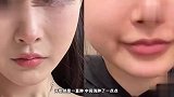 女子花4千打溶脂针，隔天脸部肿胀医生承认失误还拉黑：量打多了