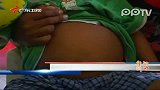 秘鲁3岁男童腹中怀孪生寄生胎