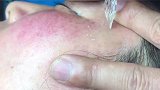 原来美容店是这样去干皮的，看完我瞬间腿软了