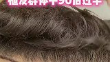 中国平均每6人就有1人脱发 植发群体中90后过半