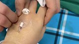 女子晒自己手术成功拔滞留针，隔着屏幕感觉到疼