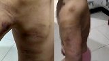 小学生作业未完成被打得浑身淤青 校方：涉事老师已停职