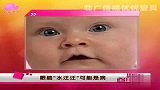 宝宝眼睛“水汪汪”可能是病