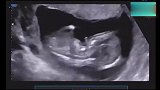 孕期第14周B超检查分享给大家，金鸡报晓接好孕，有接必中！