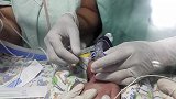 实拍医生为24周新生婴儿插管，好可怜的孩子，看着好心疼