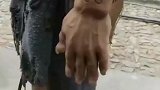 这手是怎么了，肿了吗，这样还来拍戏啊