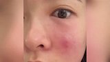 女子徒手挤痘致感染被紧急手术：医生说再严重会失明，颅内感染