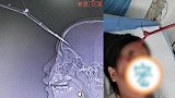 四川一9岁女孩额头插入一把剪刀 万幸手术拔出时未出血