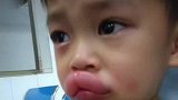 孩子吃葡萄过敏成全网最性感的“嘟嘟嘴“，网友：忍不住笑了！