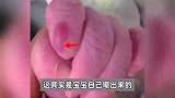 新生儿在妈妈肚子里将手指嘬破：右手近1公分长创口，左手类似烫伤的水疱