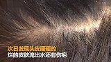 女子烫染头发头皮被烧伤溃烂 老板：是你太敏感