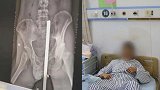 看着都疼！工人不慎坠落被钢筋穿透身体 从胯下插入左腹穿出