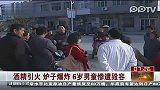 酒精引火炉子爆炸 6岁男童惨遭毁容