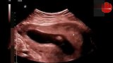 孕13周做四维彩超，胎儿10秒的心跳声，生命真的太神奇了