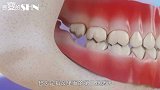 为啥人的智齿越长越疼？3D动画模拟，看完恨不得全拔掉！