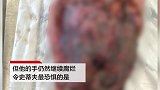 男子割破手感染罕见食肉菌 眼睁睁看着手被吃掉