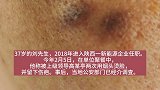 男子称遭高管“烟头烫脸”，该长记性的是职场霸凌者