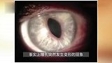 女子瞳孔突然变成三角形！医生：还会变很多种形状，不用慌