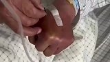 护士扎针没成功大爷自己上手