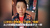 全球罕见！12岁男孩患上“吸血鬼症” 晒太阳皮肤溃烂脱皮