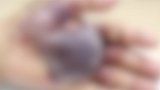 广东中山：男子被水桶刮伤，手部肿胀发紫险丧命!元凶竟是它