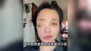 安徽一女子左眼失明，办理残疾人证被拒？残联：双眼残疾才可办理
