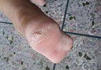 为什么越来越多人脚后跟会开裂？到底在暗示什么？很多人都想错了