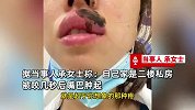 江苏一女子睡觉时被蜈蚣咬醒，嘴巴肿成香肠：超乎想象的疼