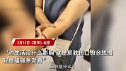 女子患怪病，皮肤可拉伸几厘米如橡皮人