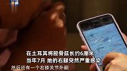 女子出国做断骨增高腿喷脓：一夜之间从肿变流脓挤也挤不完，走超过500米都要考虑