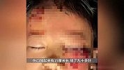 江西8岁男童遭狗扑咬，脸部缝90多针几乎毁容，妈妈发视频寻狗主
