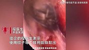 男子树下乘凉蜘蛛钻进耳朵，检查竟正结网安窝，医生：耳膜耳壁都出血了