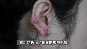 女子双耳长“葡萄”耳垂严重变形，竟因18岁起长年戴耳环不摘，医生紧急提醒